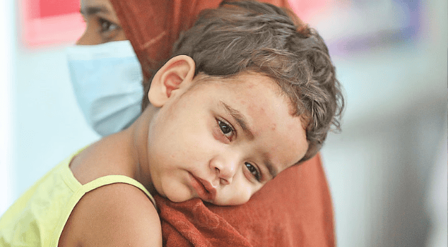 ৫৬ জেলায় ছড়িয়েছে হাম, ২১ উপজেলা উচ্চ ঝুঁকিপূর্ণ