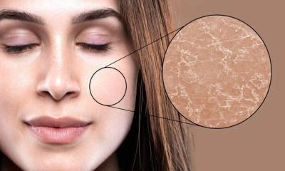 রোজায় ত্বক শুষ্ক হয়ে যাচ্ছে? যা করবেন