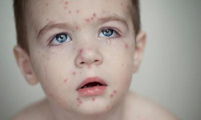 হাম কী, কেন ও কীভাবে ছড়ায় এবং শিশুরোগ বিশেষজ্ঞ জানাচ্ছেন শিশুর হাম হলে কী করবেন